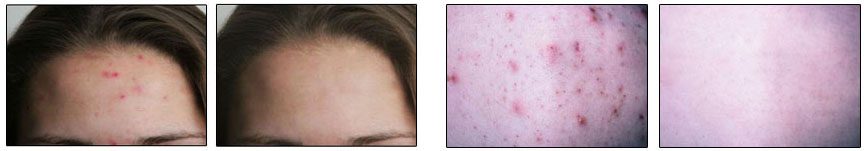 Acne - Before and After